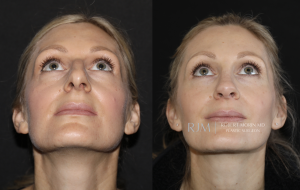  Cosmetic rhinoplasty before and after photograph Robert Morin MD