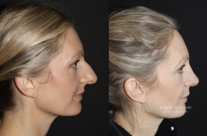  Cosmetic rhinoplasty before and after photograph Robert Morin MD