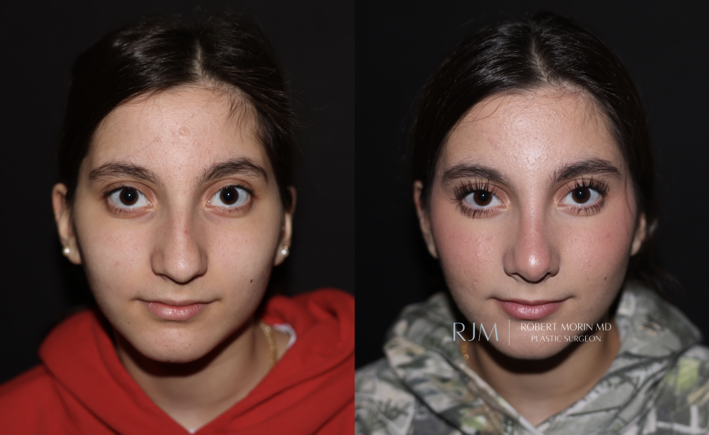  Before and after rhinoplasty photo Robert Morin MD