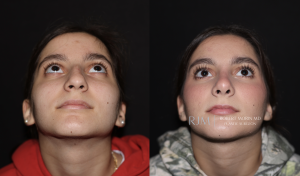  Before and after rhinoplasty photo Robert Morin MD