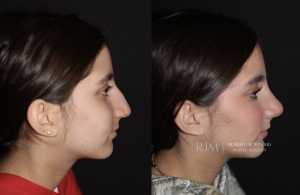  Before and after rhinoplasty photo Robert Morin MD