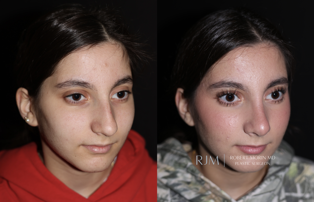  Before and after rhinoplasty photo Robert Morin MD