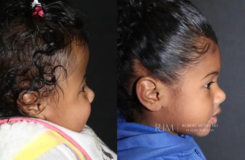 Cranial Vault Remodeling Girls Before & After Photos