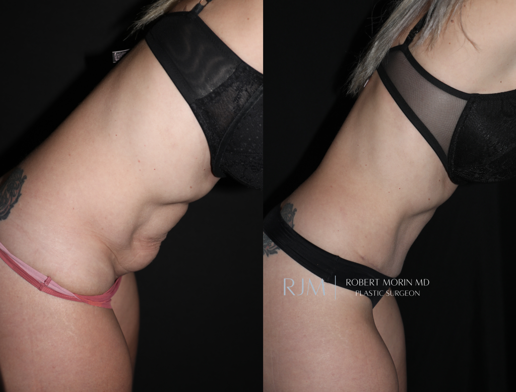  Tummy tuck before and after Robert Morin MD