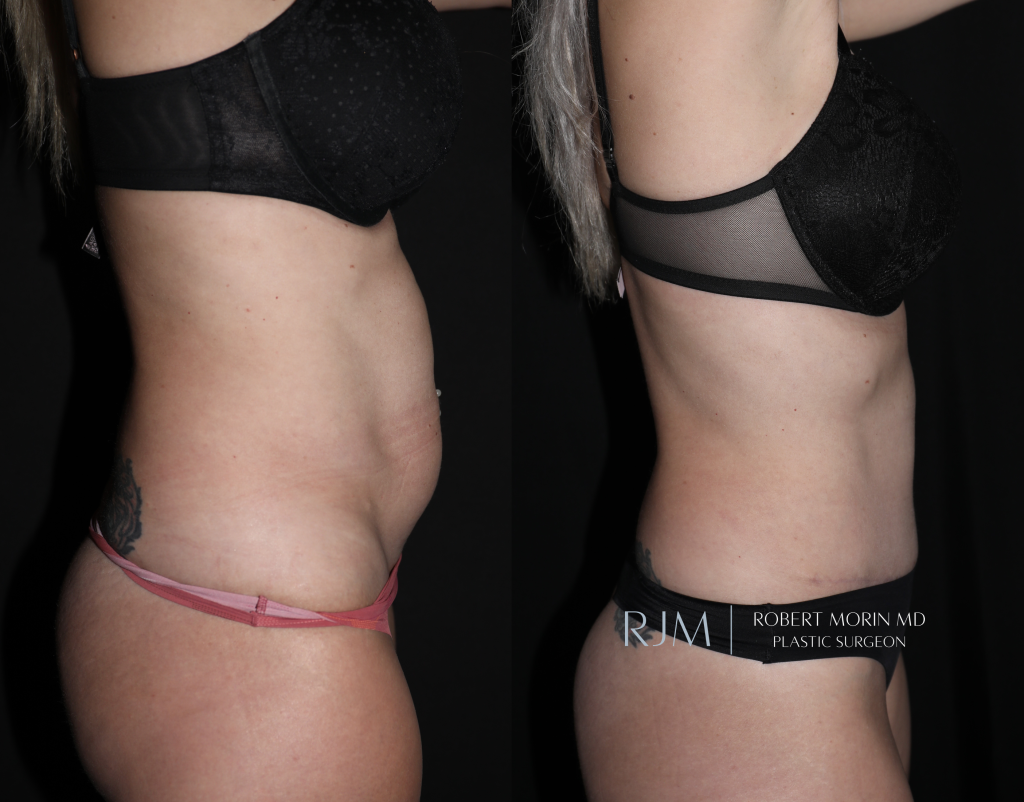  Tummy tuck before and after Robert Morin MD