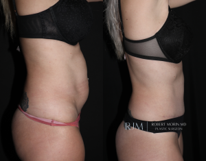  Tummy tuck before and after Robert Morin MD