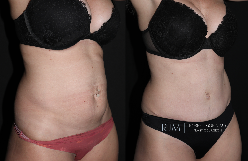  Tummy tuck before and after Robert Morin MD