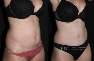  Tummy tuck before and after Robert Morin MD
