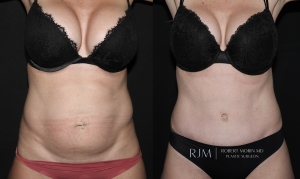  Tummy tuck before and after Robert Morin MD