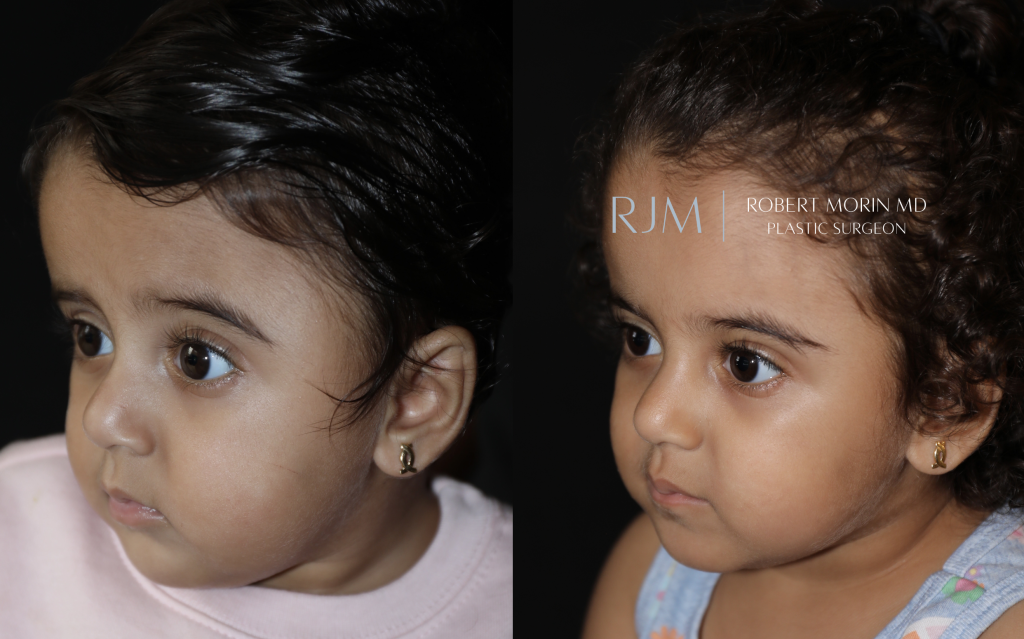  Open cranial vault remodeling left coronal craniosynostosis before and after Robert Morin MD
