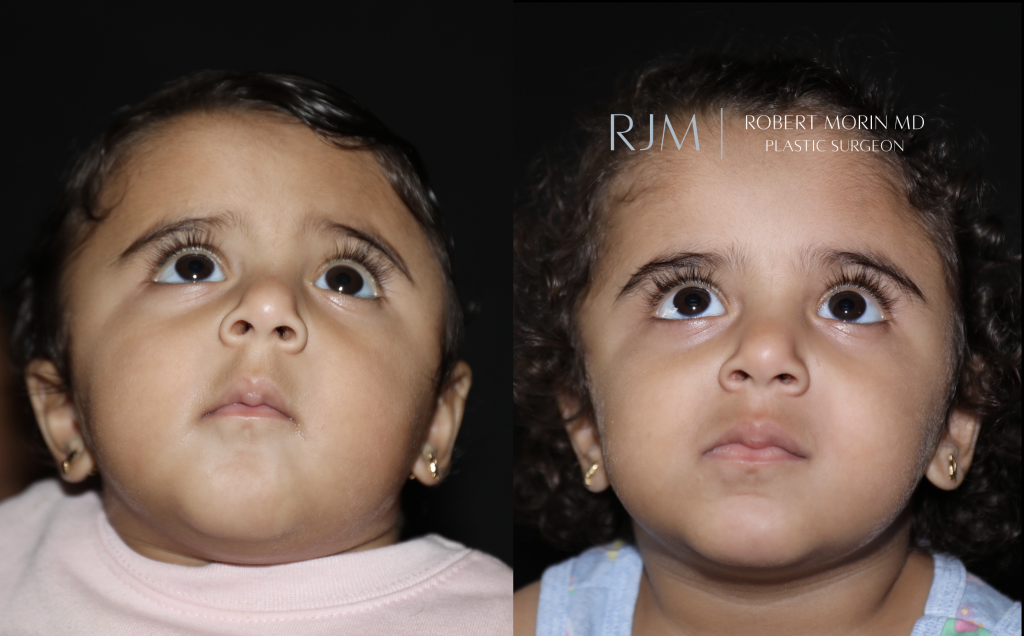  Open cranial vault remodeling left coronal craniosynostosis before and after Robert Morin MD