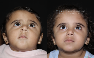  Open cranial vault remodeling left coronal craniosynostosis before and after Robert Morin MD