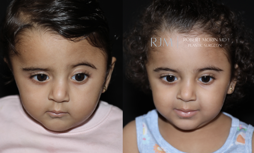  Open cranial vault remodeling left coronal craniosynostosis before and after Robert Morin MD