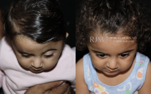  Open cranial vault remodeling left coronal craniosynostosis before and after Robert Morin MD