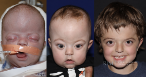  Fronto orbital advancement for bilateral coronal craniosynostosis by Robert Morin MD