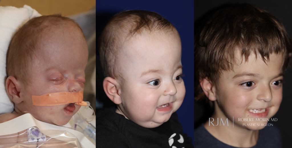  Fronto orbital advancement for bilateral coronal craniosynostosis by Robert Morin MD