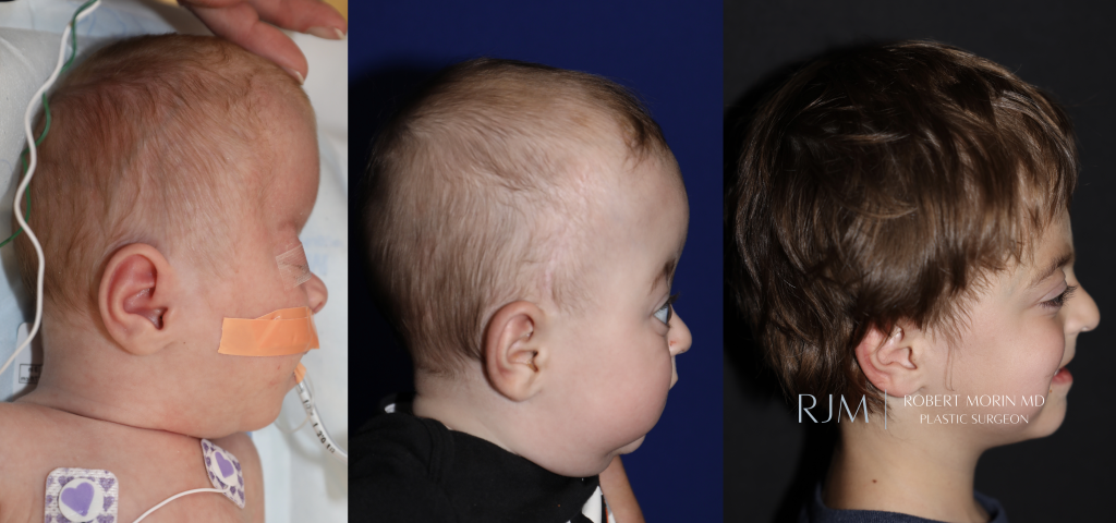 Fronto orbital advancement for bilateral coronal craniosynostosis by Robert Morin MD