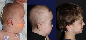  Fronto orbital advancement for bilateral coronal craniosynostosis by Robert Morin MD