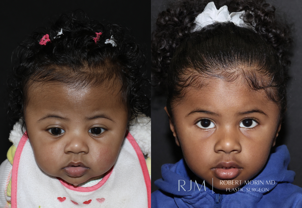  Fronto orbital advancement for bilateral coronal craniosynostosis by Robert Morin MD