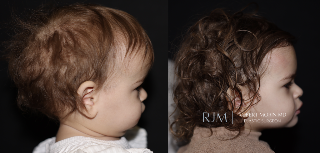  Cranial vault remodeling for sagittal craniosynostosis before and after photos by Robert Morin MD