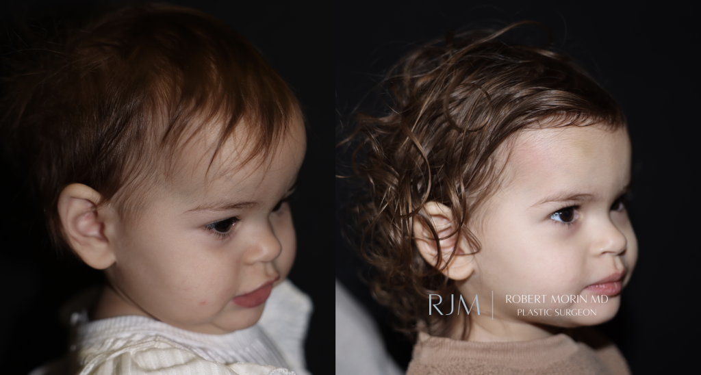  Cranial vault remodeling for sagittal craniosynostosis before and after photos by Robert Morin MD
