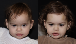  Cranial vault remodeling for sagittal craniosynostosis before and after photos by Robert Morin MD