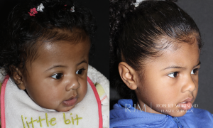  Bilateral coronal craniosynostosis before and after cranial vault remodeling performed by Robert Morin MD