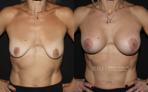  Breast augmentation and lift before and after photographs by Dr. Robert Morin