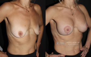  Breast augmentation and lift before and after photographs by Dr. Robert Morin