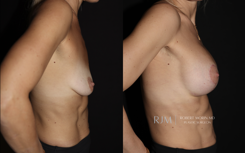  Breast augmentation and lift before and after photographs by Dr. Robert Morin