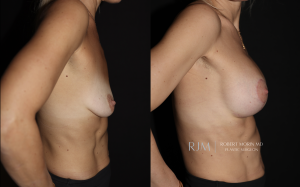  Breast augmentation and lift before and after photographs by Dr. Robert Morin