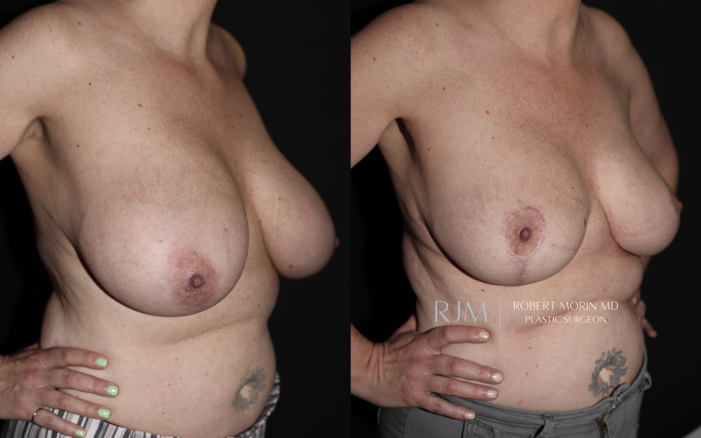  Breast reduction before and after photographs Robert Morin MD