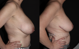  Breast reduction before and after photographs Robert Morin MD