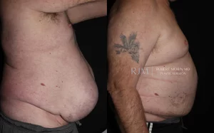  Abdominal wall reconstruction for ventral hernia before and after photographs
