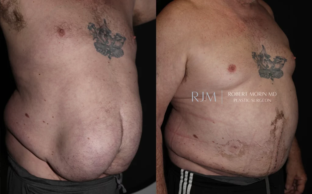  Abdominal wall reconstruction for ventral hernia before and after photographs