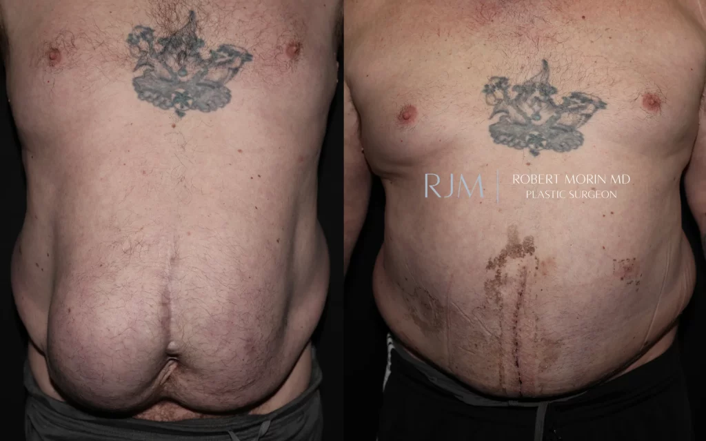  Before-and-after photographs of abdominal wall reconstruction for ventral hernia performed by Dr. Morin