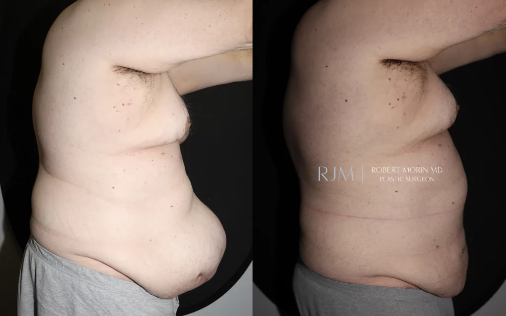  Before-and-after photographs of abdominal wall reconstruction and ventral hernia repair by Dr. Morin
