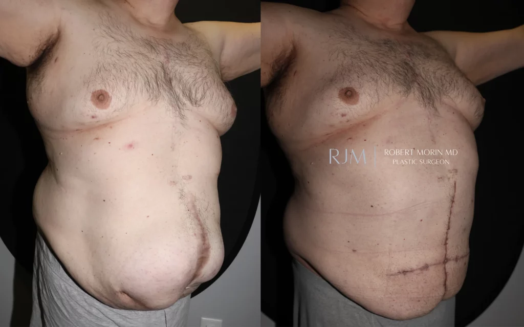  Before-and-after photographs of abdominal wall reconstruction and ventral hernia repair by Dr. Morin