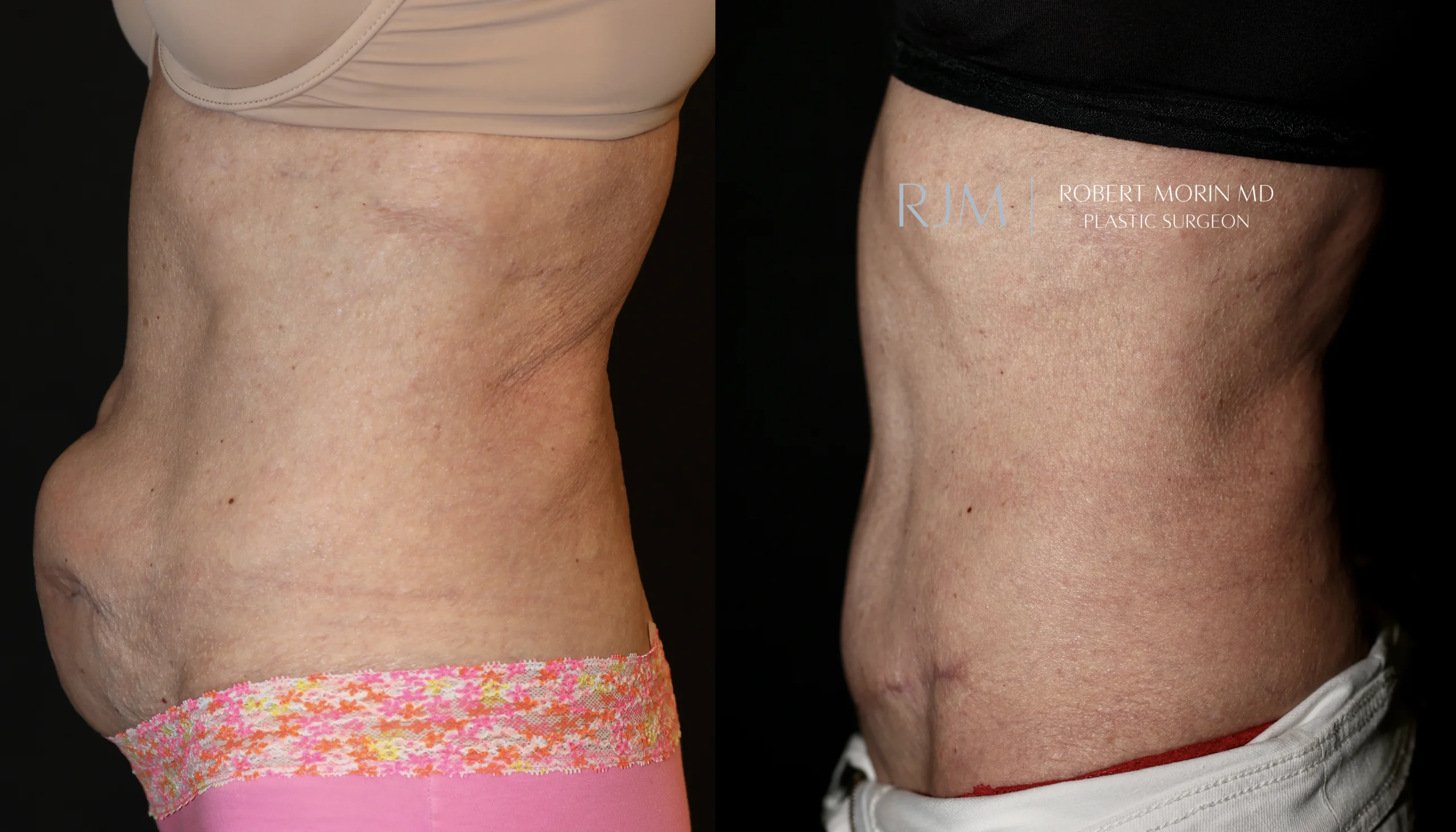 Abdominal wall reconstruction for ventral hernia before and after photograph Robert Morin MD