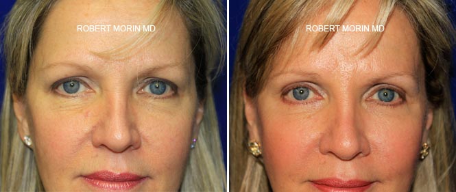 Woman's face, before and after blepharoplasty treatment, front view