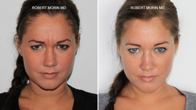 botox Before & After Photos