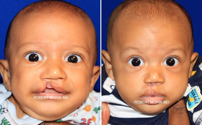 Cleft lip and cleft palate. Before & After Photos
