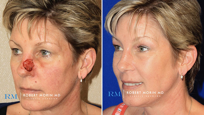 Woman's face, Before & After Nasal Reconstruction Treatment, l-side oblique view