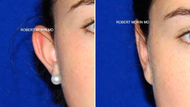 Before & After Otoplasty