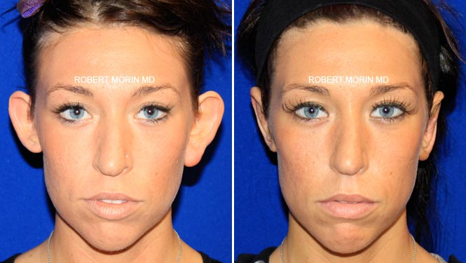 Woman's face, before and after otoplasty treatment, fron view, patient 3