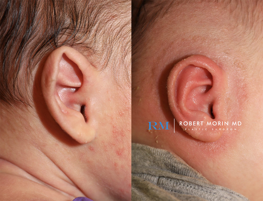 Before and After earwell  patient 1