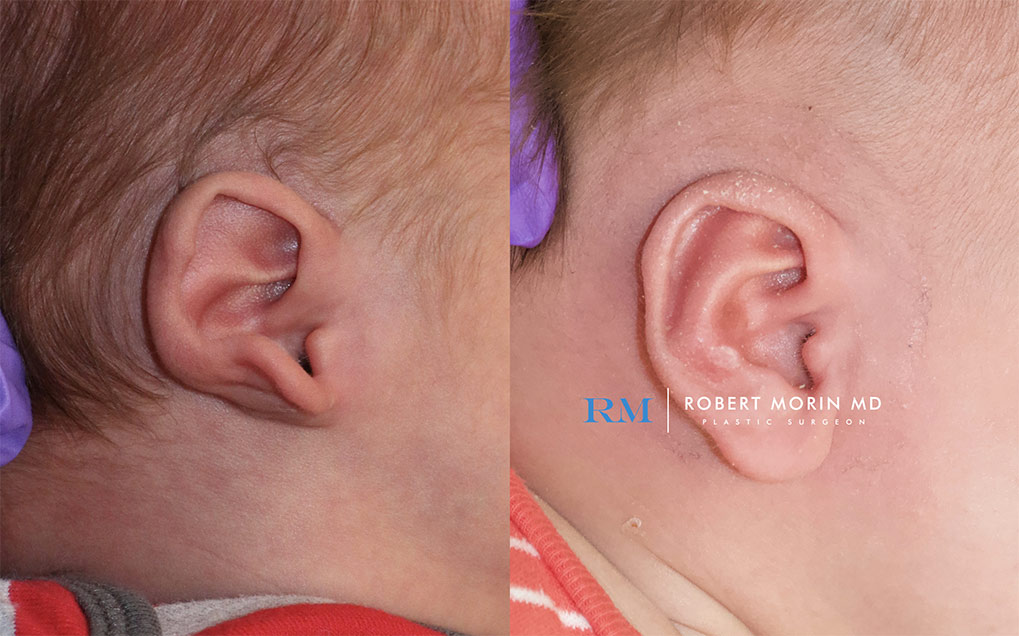 Before and After earwell  patient 1