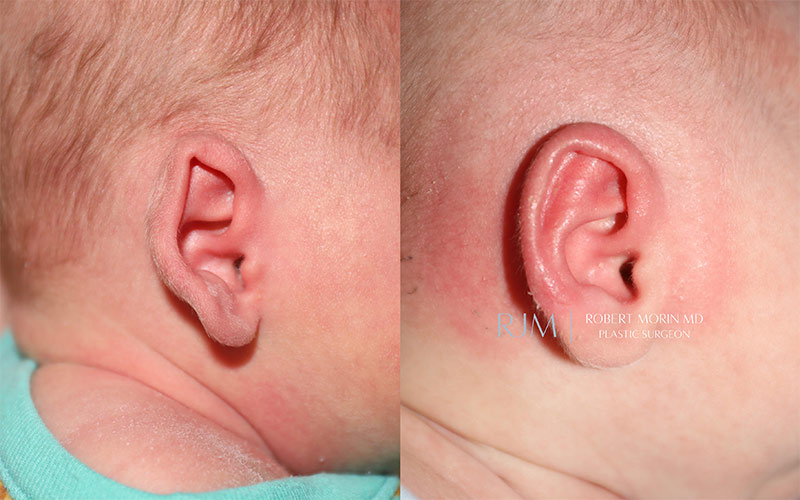 Before and After earwell  patient 1