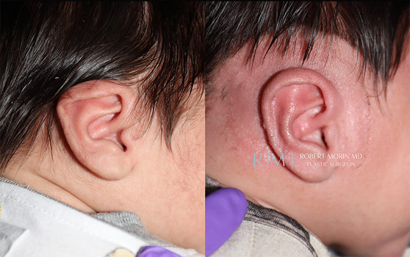 Before and After earwell  patient 1