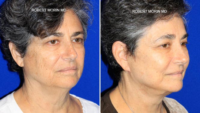 Woman's face, before and after Facelift Surgery treatment, oblique view, patient 2